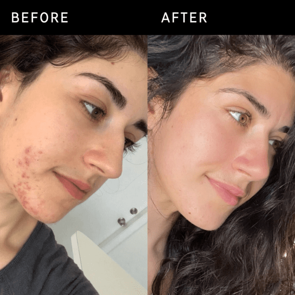 THE INKEY LIST Succinic Acid Acne Treatment - Image 2
